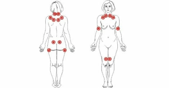puntos-mas-comunes-fibromialgia